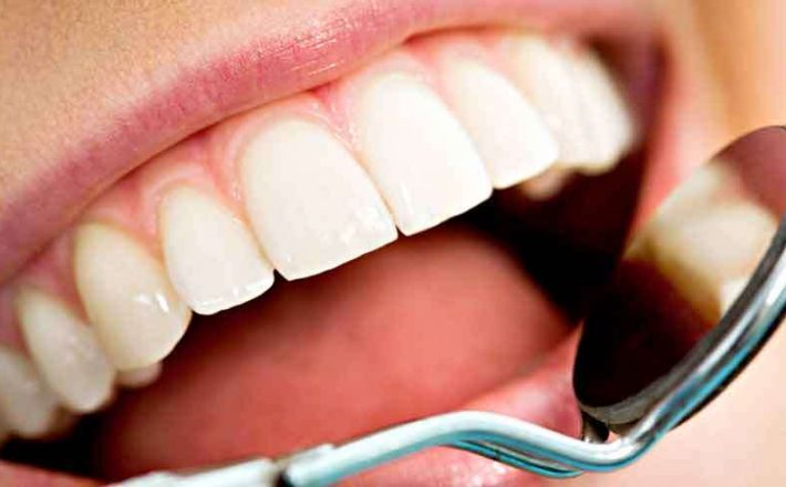 Conheça os riscos do clareamento dental