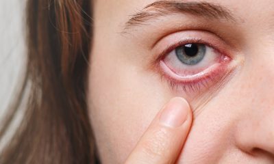 Falta de cuidados no uso de lentes de contato aumenta o risco de complicações oculares